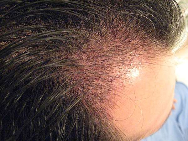 Above is a typical next day appearance of a patients scalp.